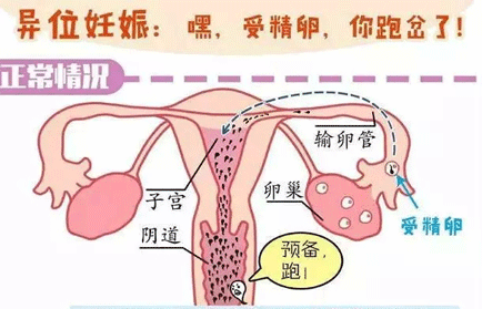 腹腔妊娠的治疗