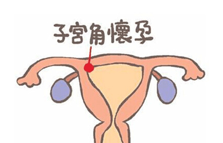 腹腔妊娠的原因