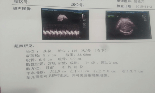 彩超单看胎儿性别