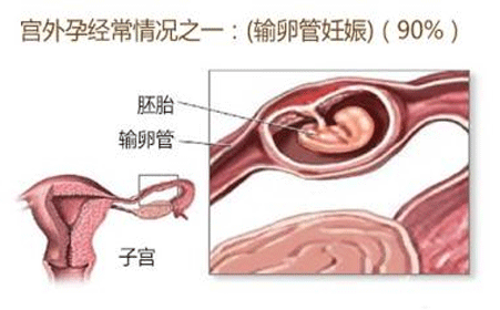 宫外孕的表现