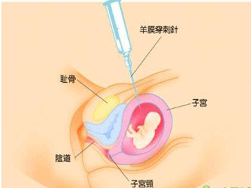 羊水穿刺什么时候做