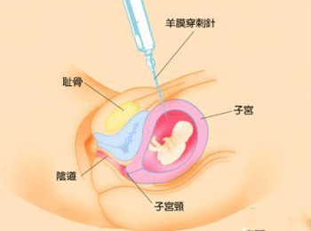 做羊水穿刺后注意事项