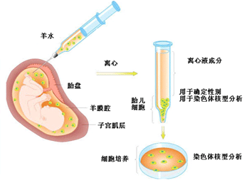 做羊水穿刺前注意事项