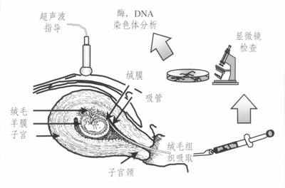 绒毛穿刺有必要做吗