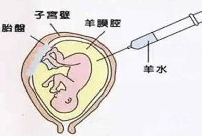 羊水穿刺时间