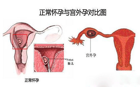 宫外孕一定会流血吗