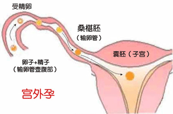 宫外孕用试纸能试出来吗