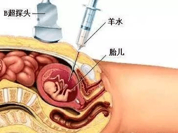 做羊水穿刺注意事项