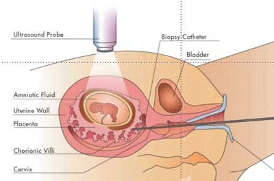 做绒毛穿刺前注意事项