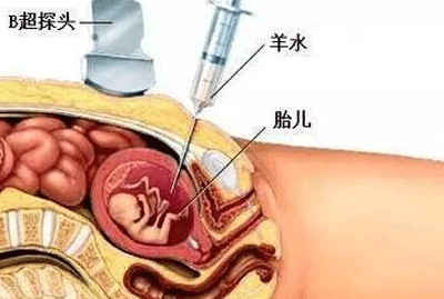 羊水穿刺注意事项