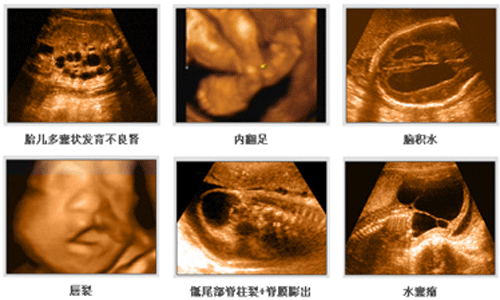 四维彩超检查什么