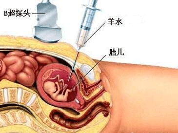 血性羊水的原因