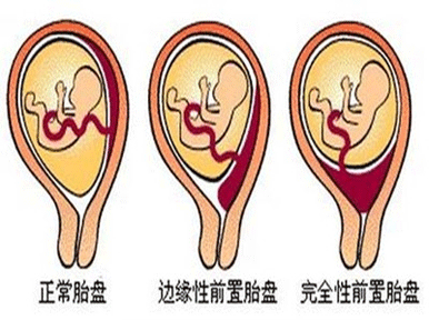 胎盘位于子宫前壁能顺产吗